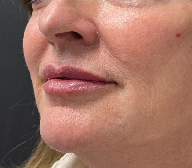 Liquid Facelift Before & After