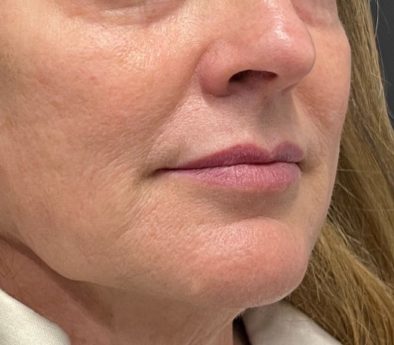 Liquid Facelift Before & After