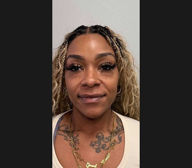 Liquid Facelift Before & After