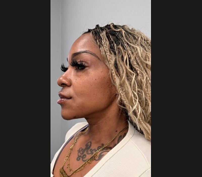 Liquid Facelift Before & After