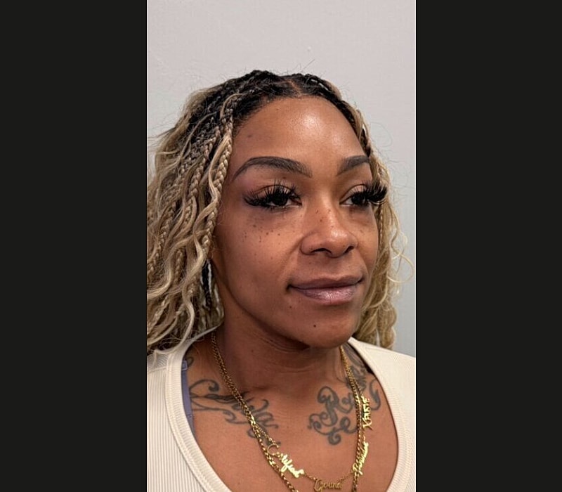 Liquid Facelift Before & After