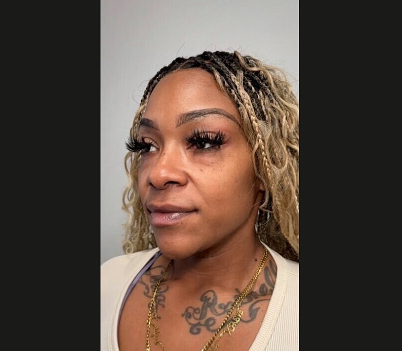 Liquid Facelift Before & After