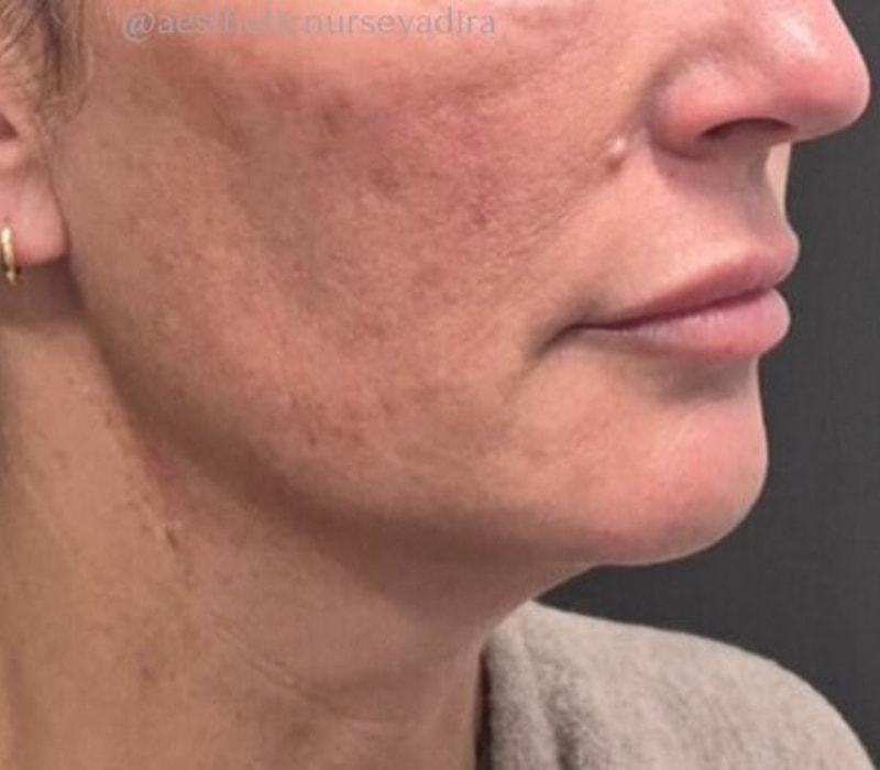 Liquid Facelift Before & After