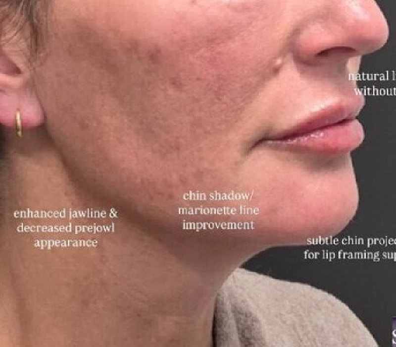 Liquid Facelift Before & After