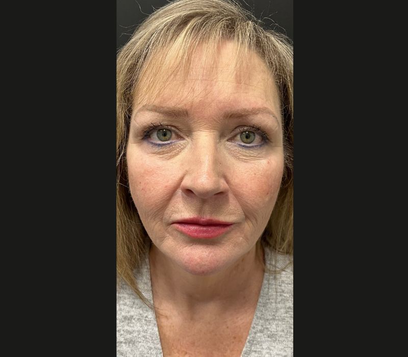 Liquid Facelift Before & After