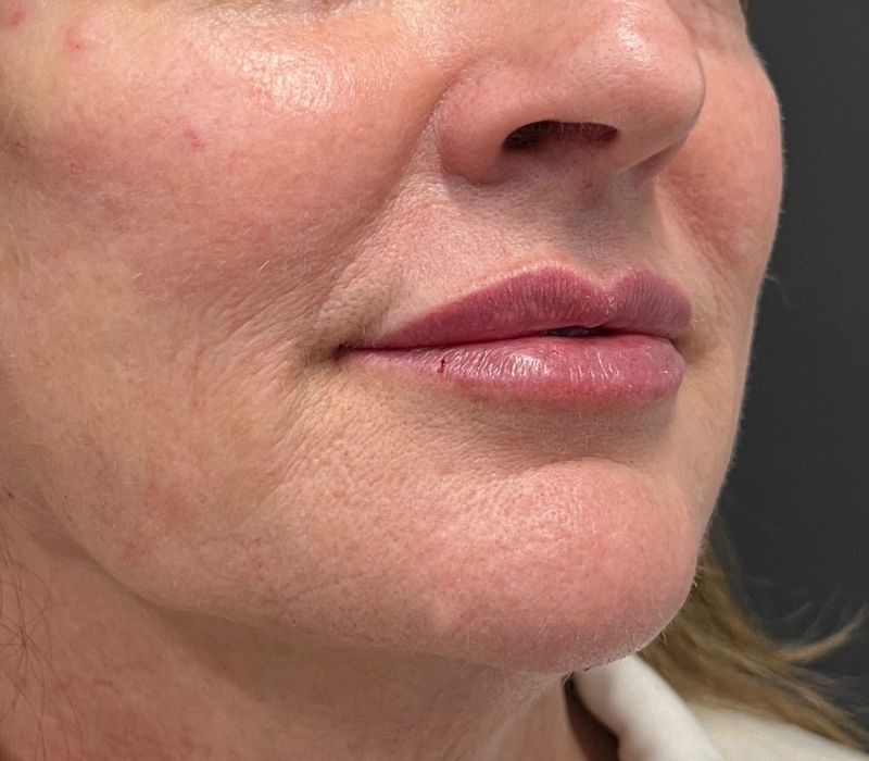 Liquid Facelift Before & After