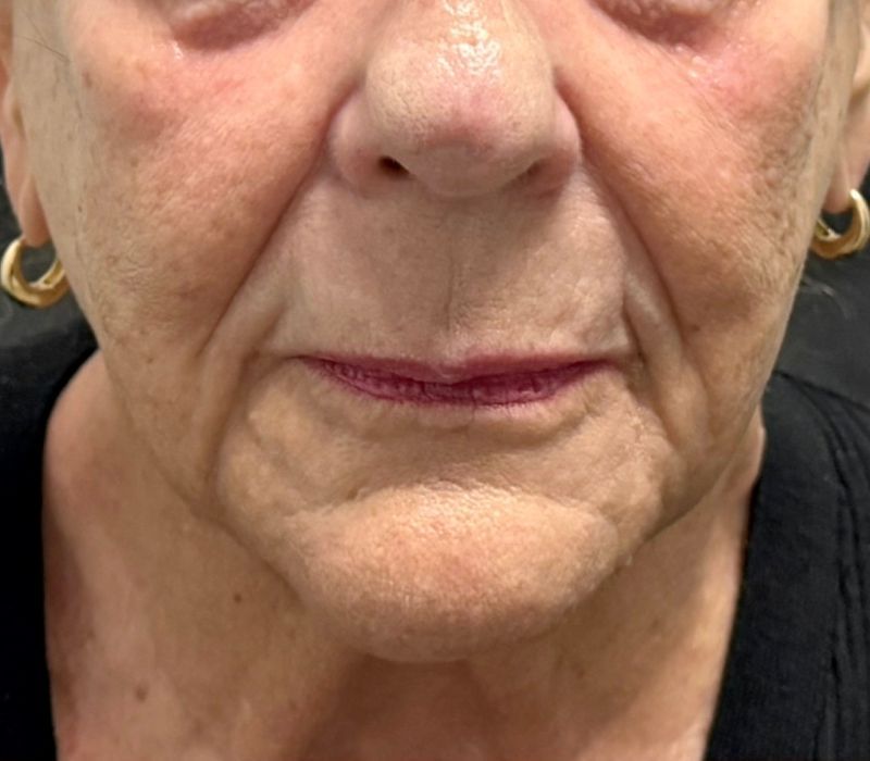 Liquid Facelift Before & After