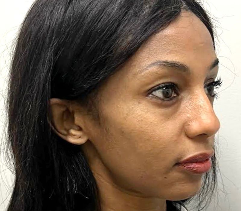 Liquid Facelift Before & After