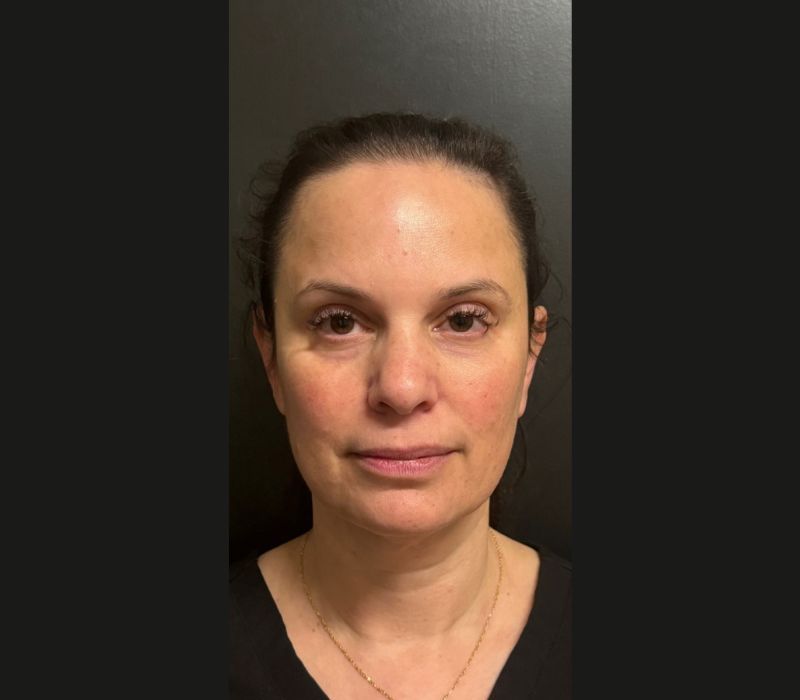 Liquid Facelift Before & After