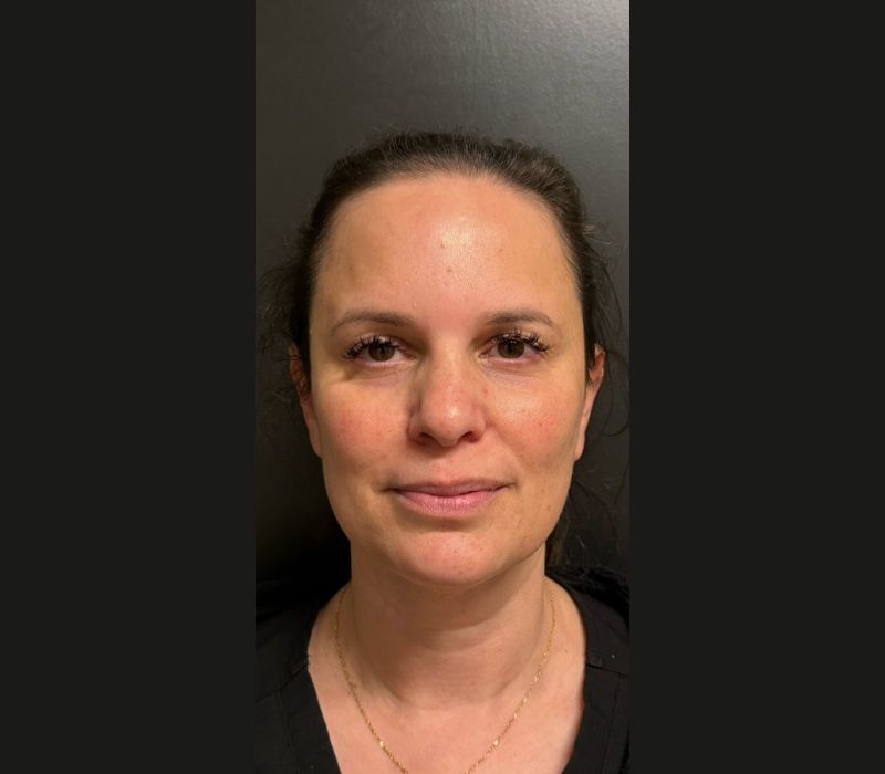 Liquid Facelift Before & After