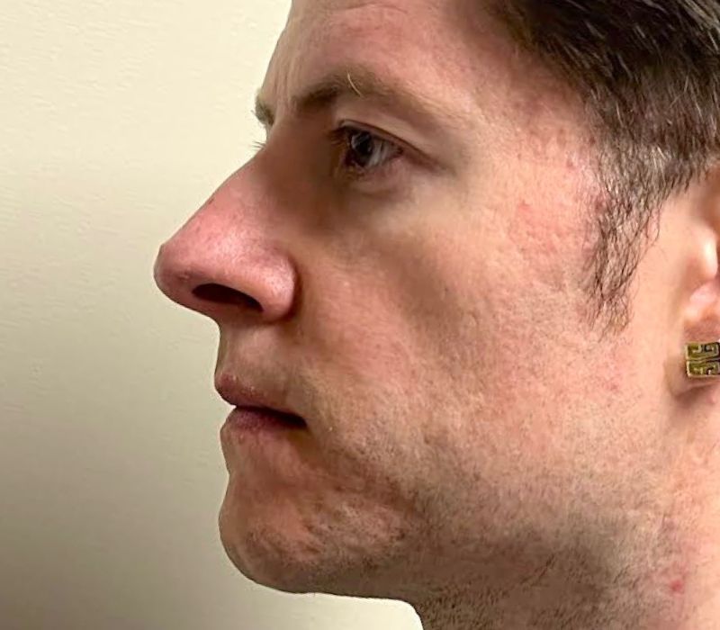 Liquid Facelift Before & After