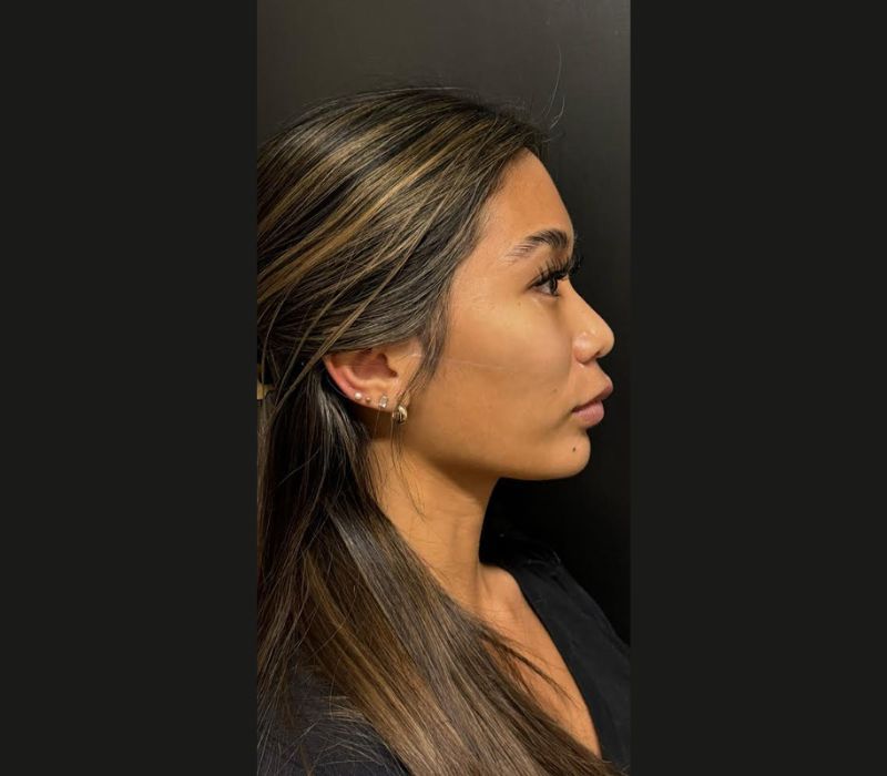 Liquid Facelift Before & After