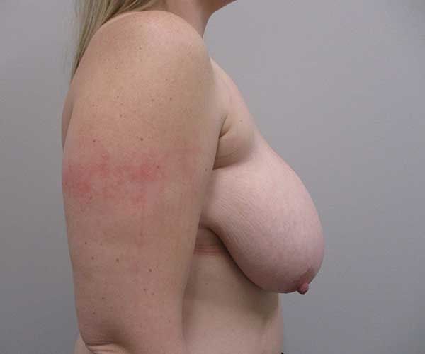Breast Reduction Before & After