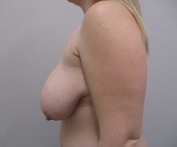 Breast Reduction Before & After