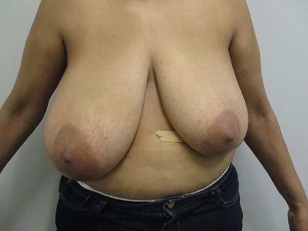 Breast Reduction Before & After