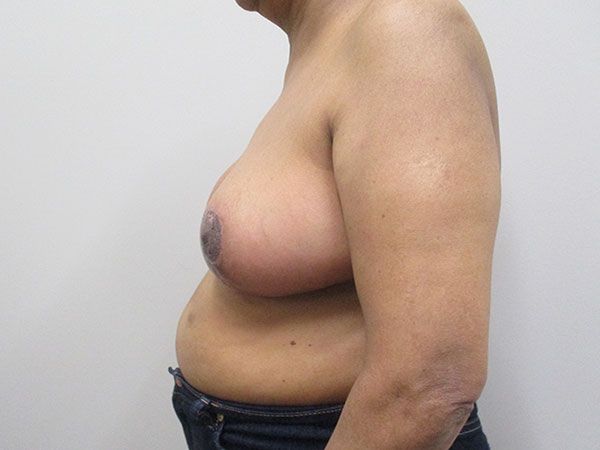 Breast Reduction Before & After
