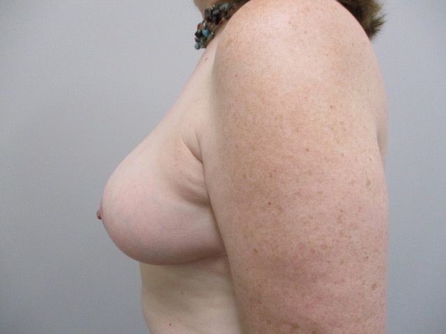 Breast Reduction Before & After