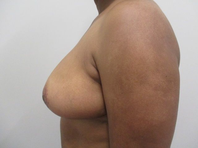 Breast Reduction Before & After