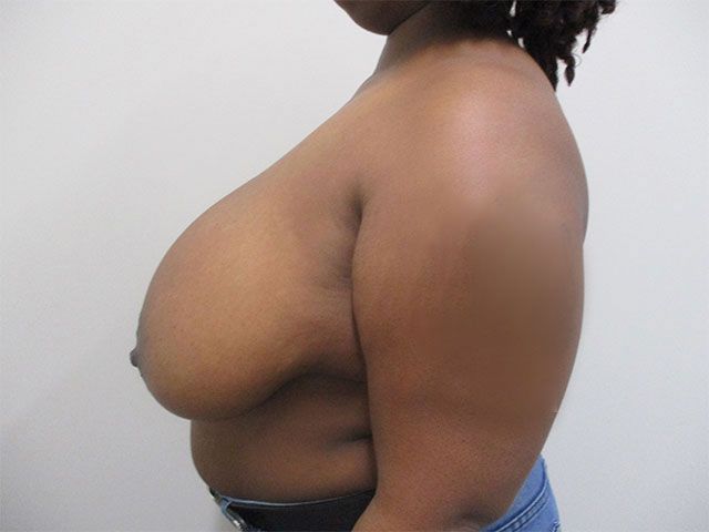 Breast Reduction Before & After