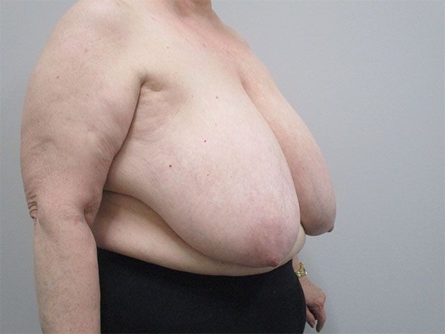 Breast Reduction Before & After