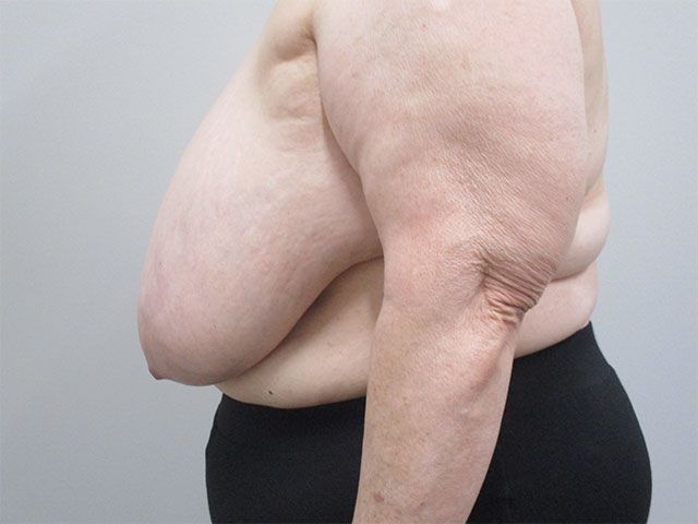 Breast Reduction Before & After
