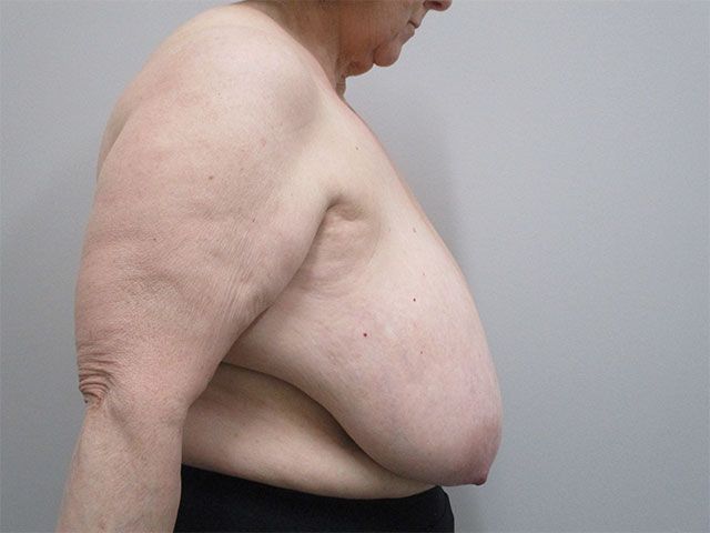 Breast Reduction Before & After