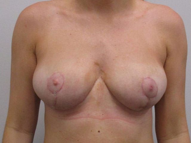 Breast Reduction Before & After