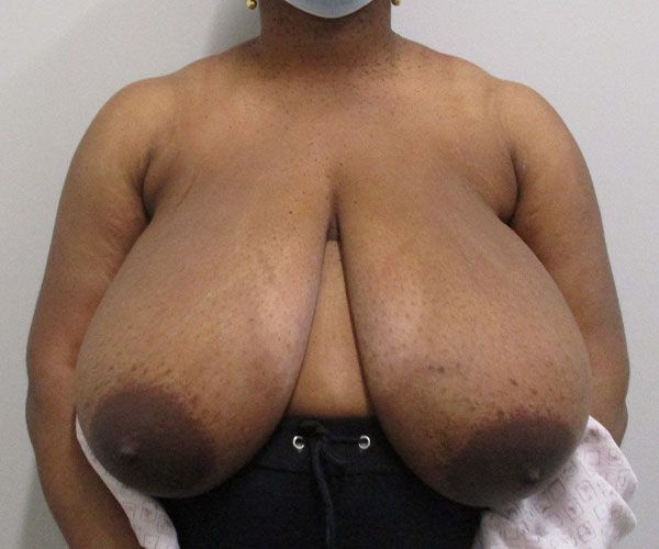Breast Reduction Before & After