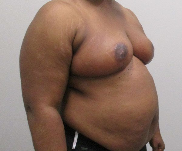 Breast Reduction Before & After