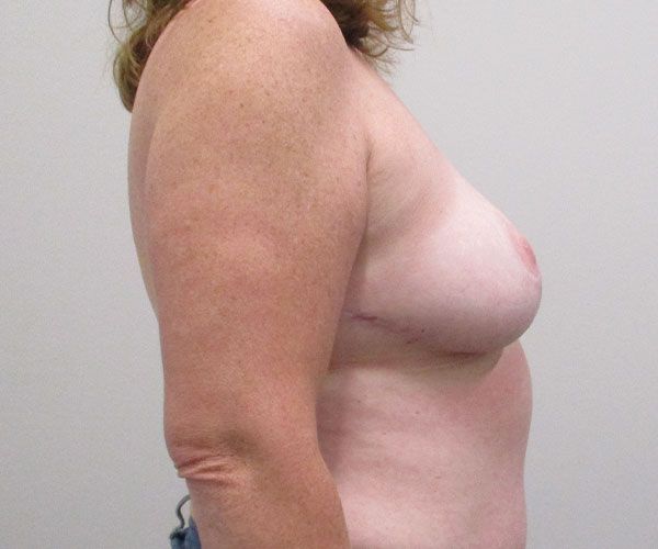Breast Reduction Before & After