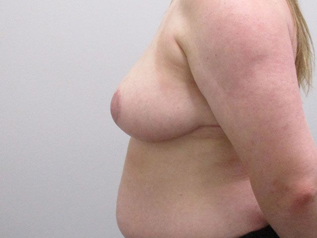 Breast Reduction Before & After
