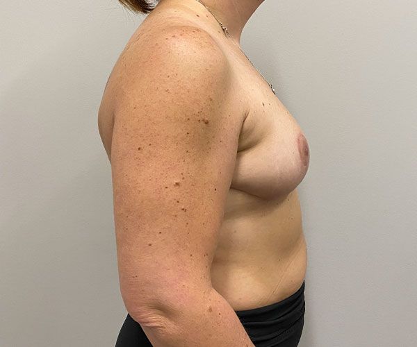 Breast Reduction Before & After