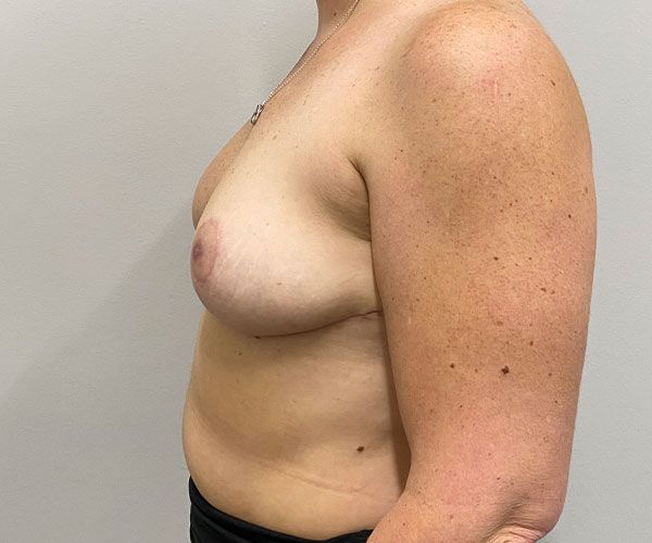 Breast Reduction Before & After