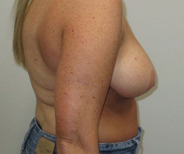 Breast Reduction Before & After
