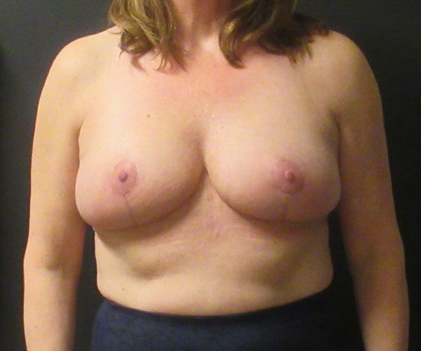 Breast Reduction Before & After
