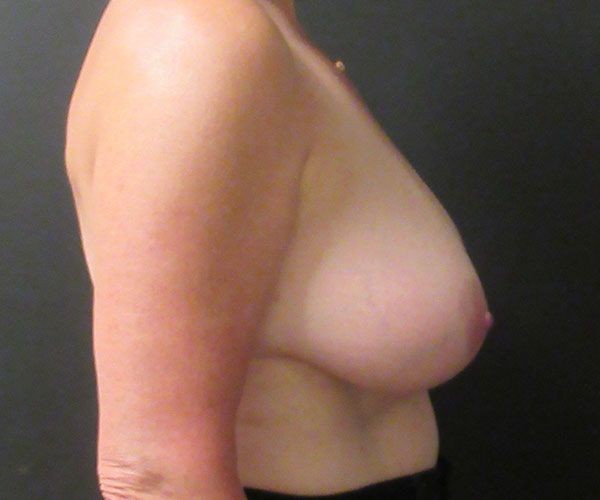 Breast Reduction Before & After