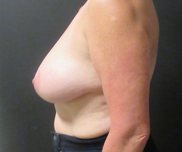 Breast Reduction Before & After