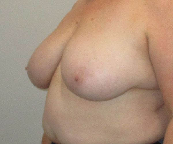 Breast Reduction Before & After