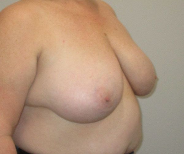 Breast Reduction Before & After