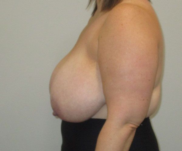 Breast Reduction Before & After