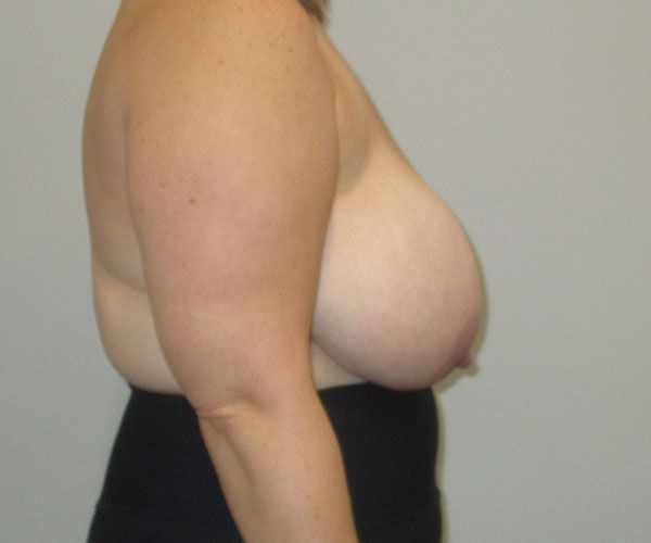 Breast Reduction Before & After