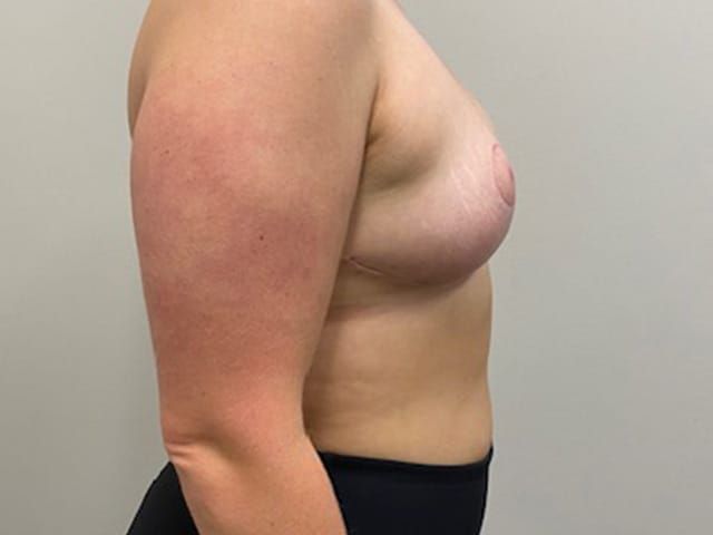 Breast Reduction Before & After