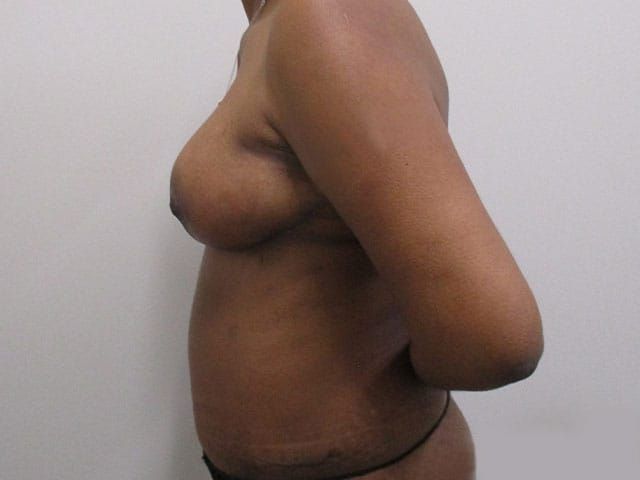 Mommy Makeover Before & After