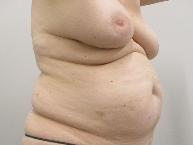 Mommy Makeover Before & After