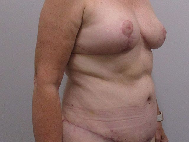 Mommy Makeover Before & After