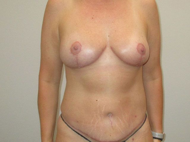 Mommy Makeover Before & After