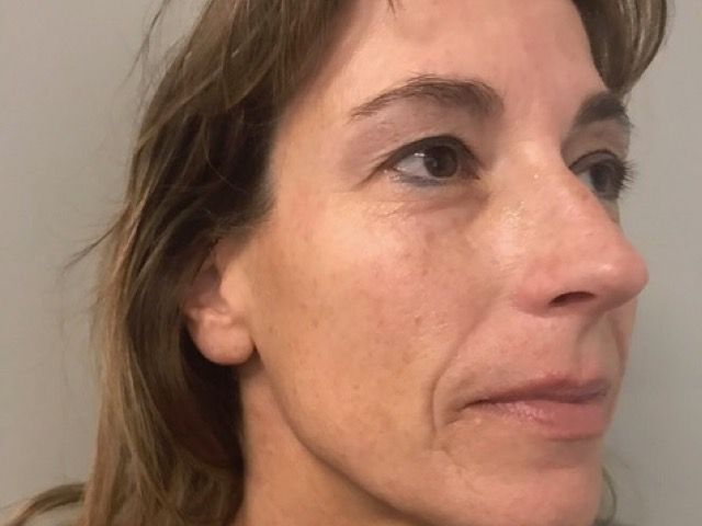 Microneedling Before & After