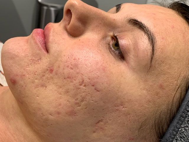 Microneedling Before & After