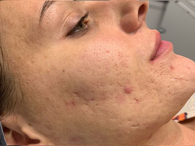 Microneedling Before & After