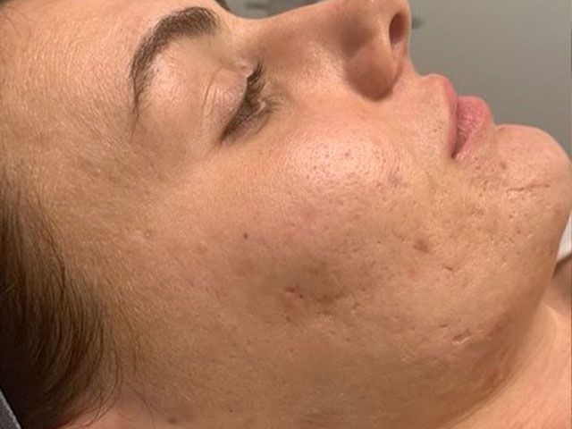 Microneedling Before & After